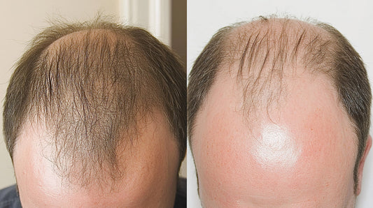 How to Regrow Bald Spots Naturally with Zinlie Hair Oil